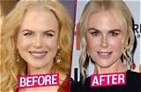All About Nikole Kidman's Plastic Surgery Procedures: Before and After